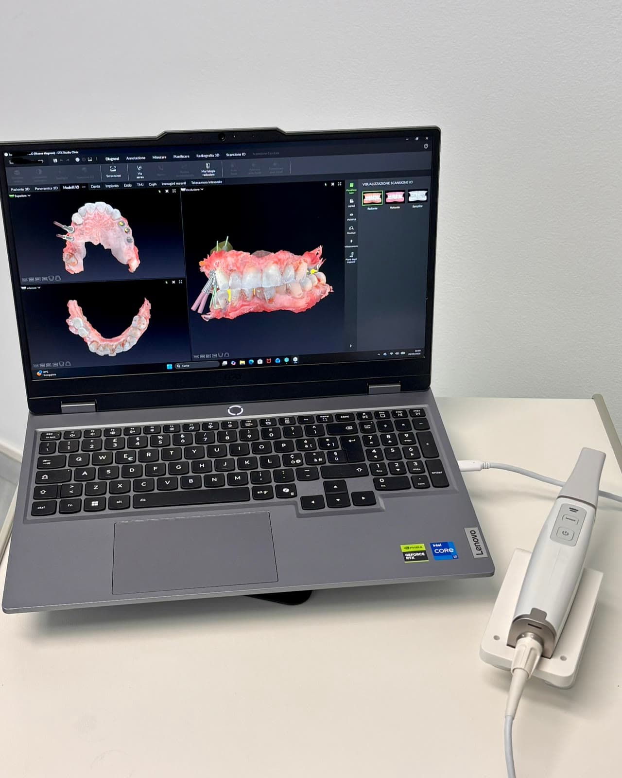 Lo scanner intraorale dello studio accanto al computer, con la scansione 3D delle arcate e il progetto degli impianti
